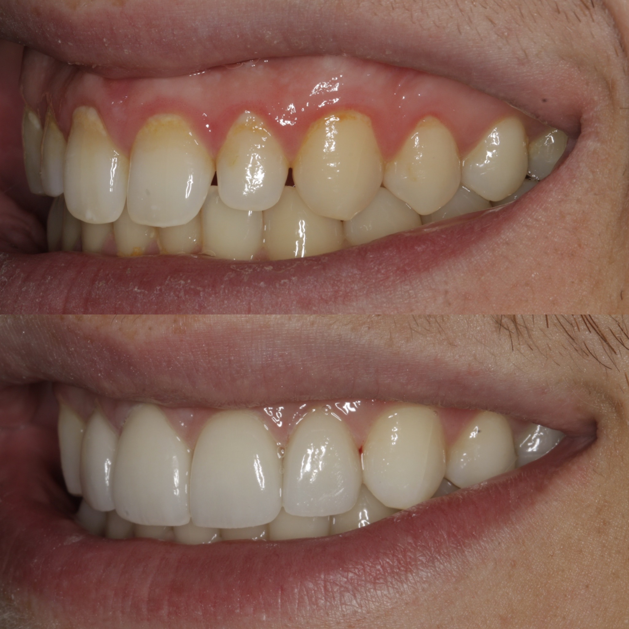 Porcelain Veneers In Edinburgh Dental Veneers Near Me