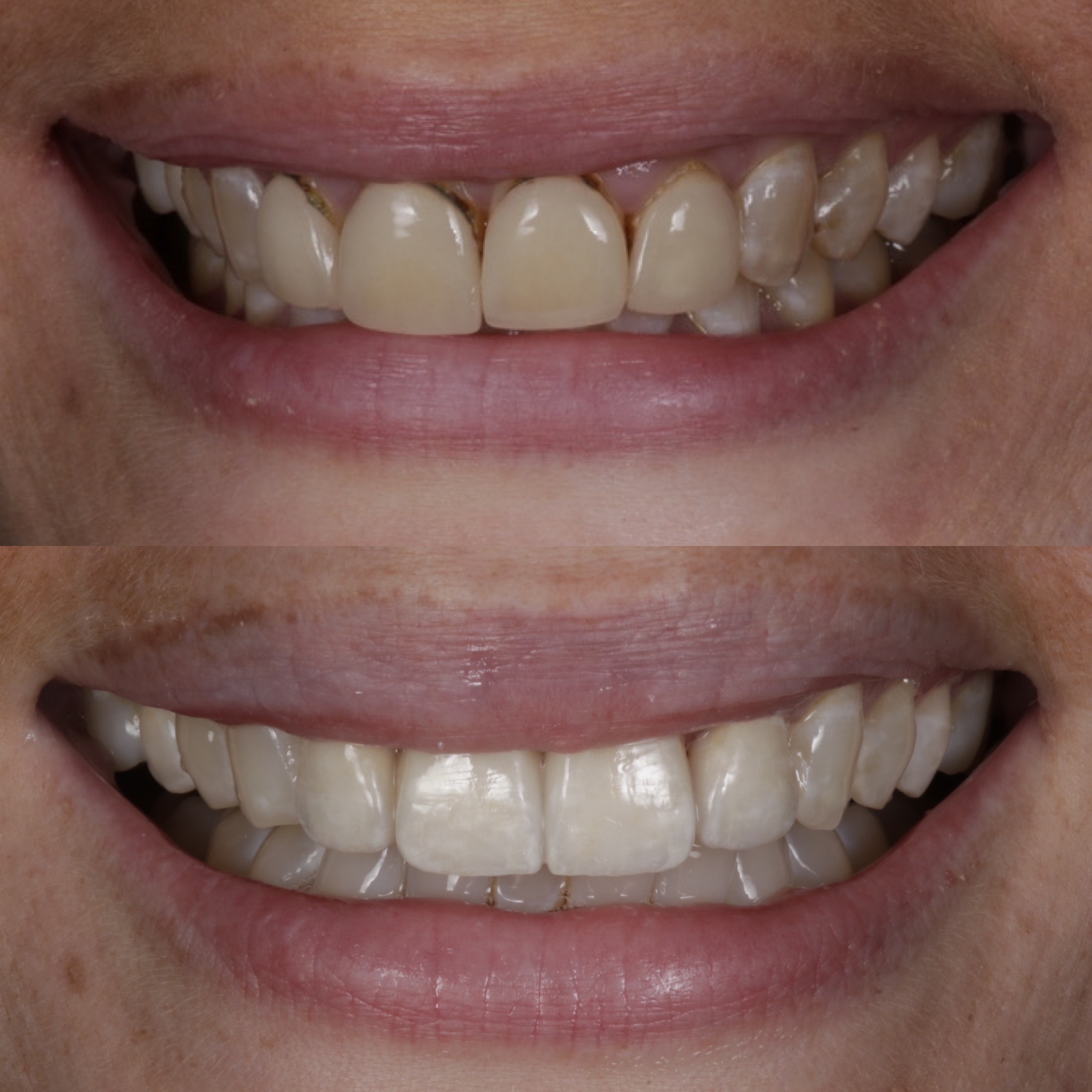 Porcelain Veneers In Edinburgh Dental Veneers Near Me