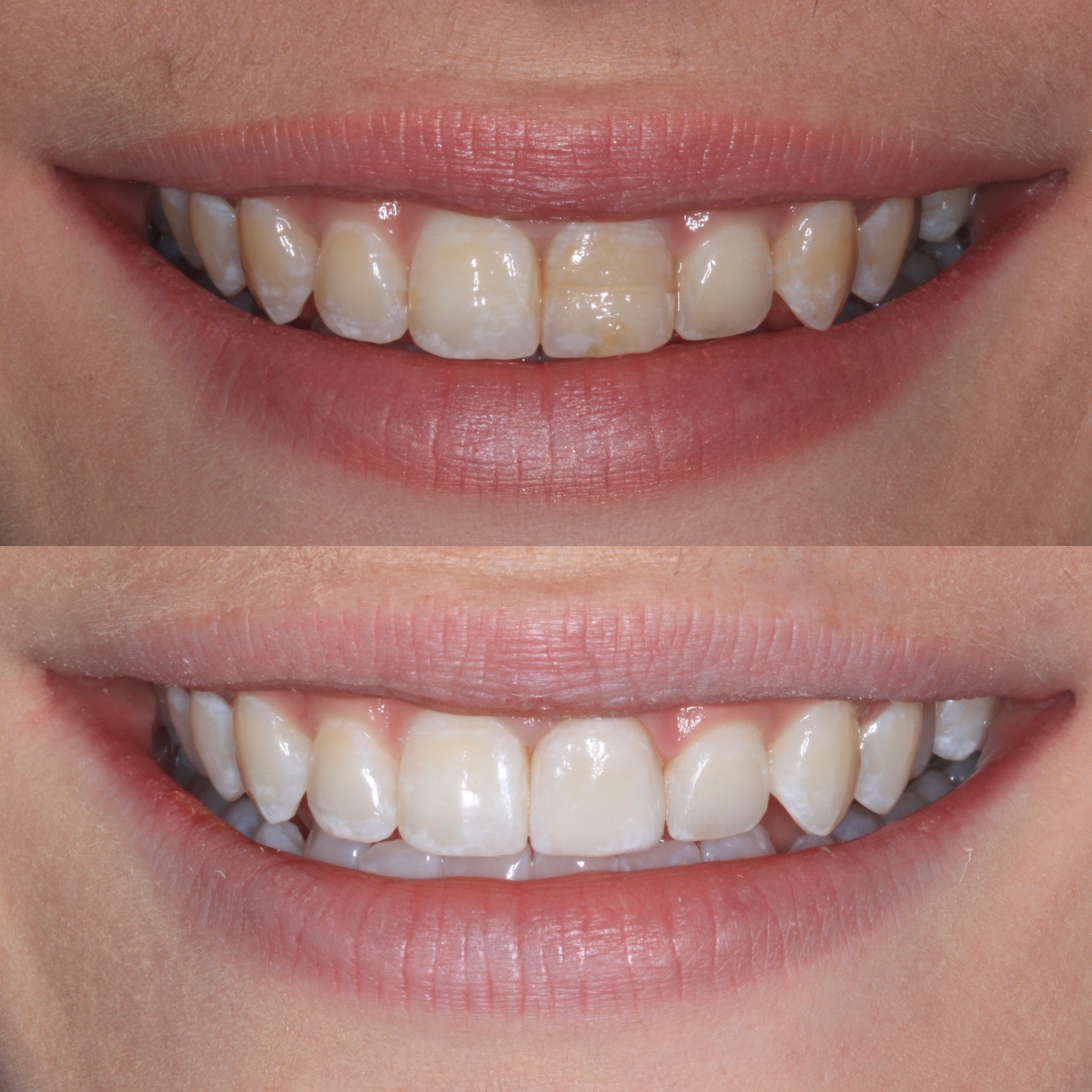 Teeth Whitening Near Me Edinburgh The Row