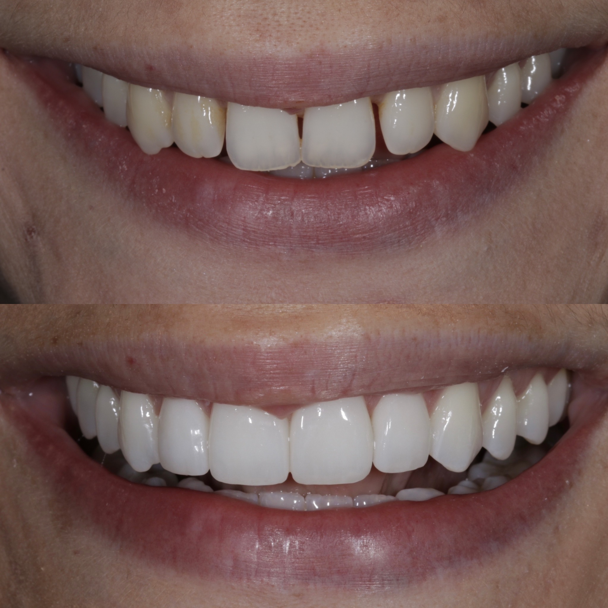 Porcelain Veneers In Edinburgh Dental Veneers Near Me
