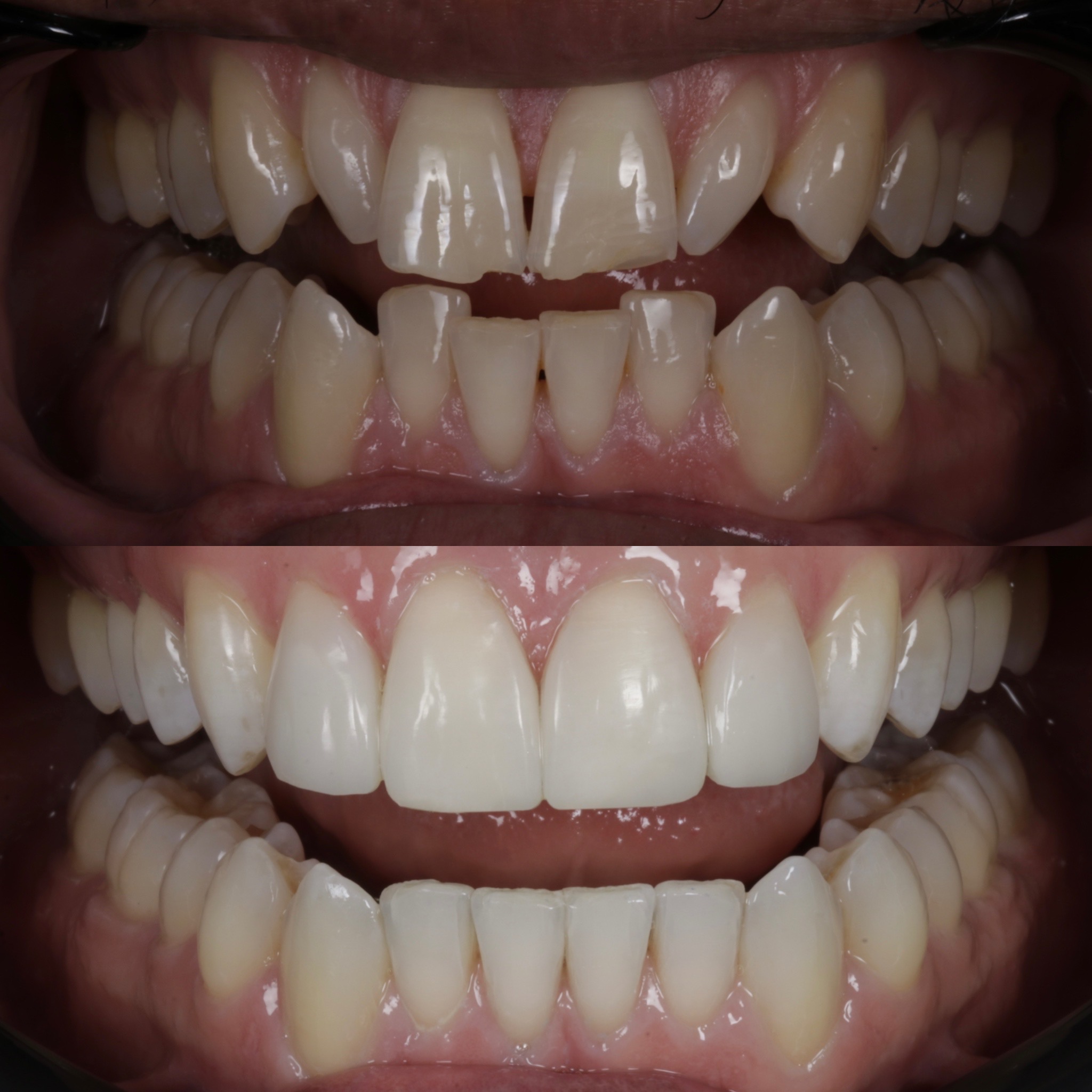 Teeth Whitening Near Me Edinburgh The Row