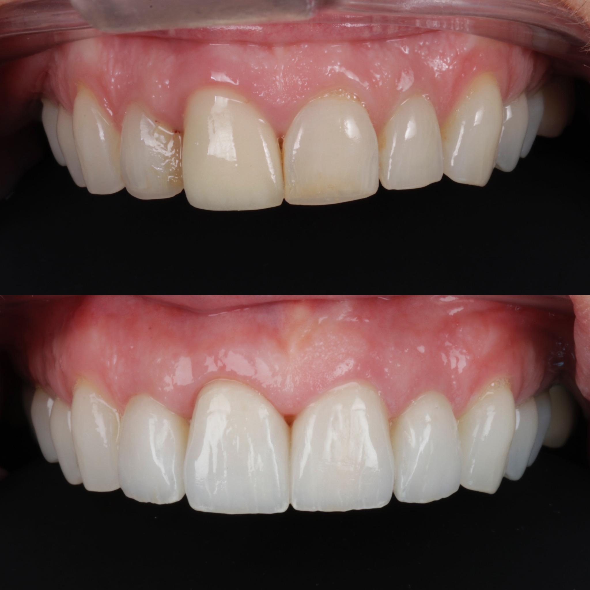 Porcelain Veneers In Edinburgh Dental Veneers Near Me