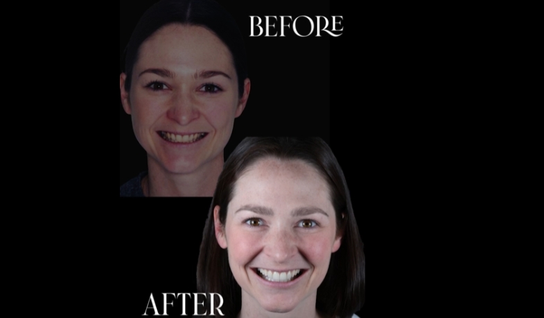 Before and after photographs of patient Hanna's smile following Invisalign