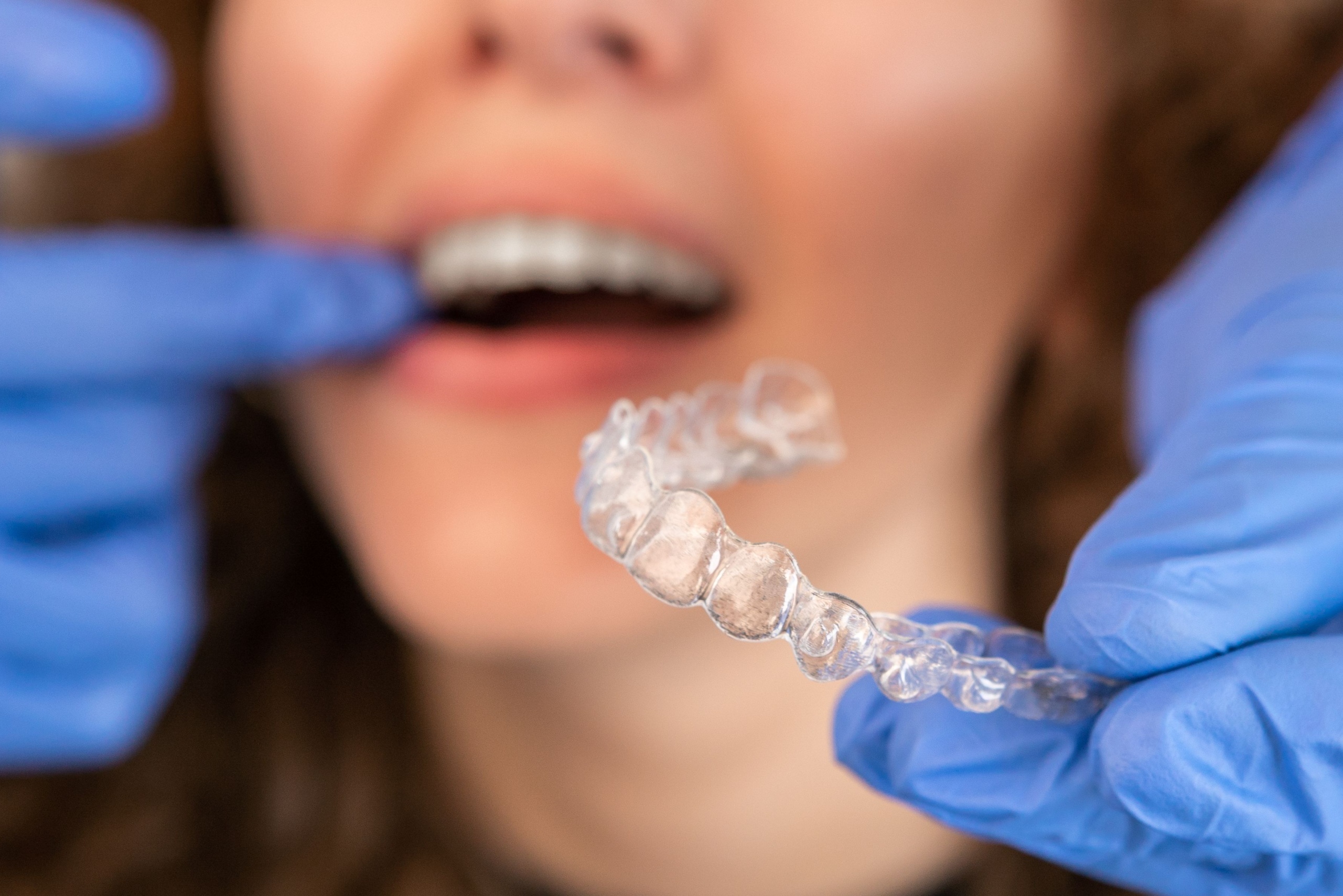 Is Invisalign Right for Me? The Questions You Need to Ask About Teeth Straightening